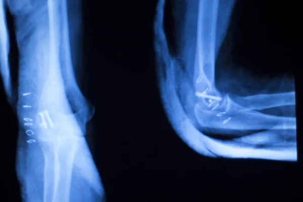 Chirurgisches Implantat Arm Ellbogen Röntgenuntersuchung — Stockfoto