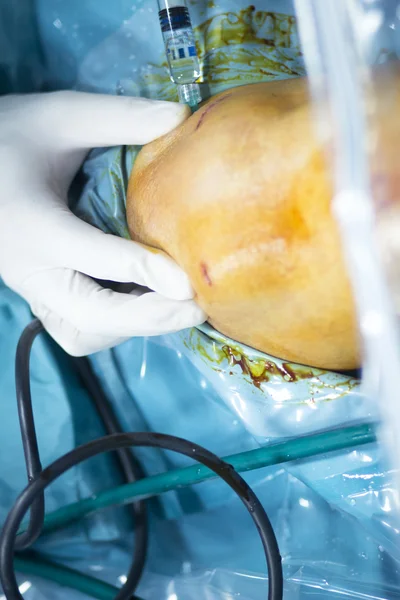 Cirugía ortopédica operación de menisco —  Fotos de Stock
