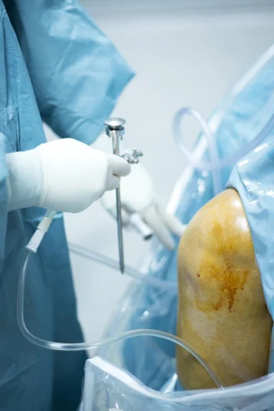 Knä artroskopi ortopedisk kirurgi drift — Stockfoto