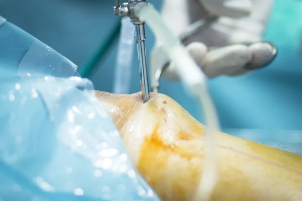 Ortopedia cirurgia do joelho operação hospitalar — Fotografia de Stock