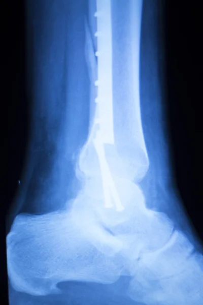 Πόδι, αστράγαλο και κνήμη xray σάρωση — Φωτογραφία Αρχείου