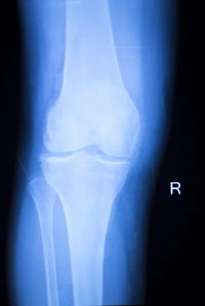 Examen de rayos X de menisco articular de rodilla —  Fotos de Stock
