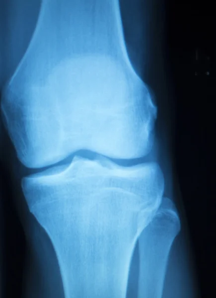 Knee joint meniscus x-ray test scan — Stock Photo, Image