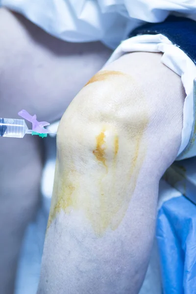 Анестетическая инъекция колена — стоковое фото