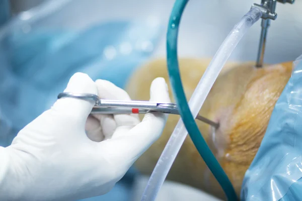 Ортопедії травматології хірургічна операція — стокове фото