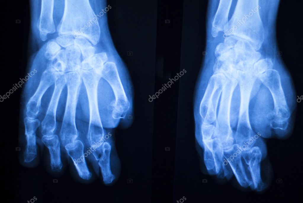 Dolor articular dedo pulgar