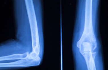Cerrahi implant kol dirsek xray sınama taraması