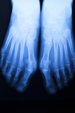 Ayak ve ayak parmakları yaralanma x-ray tarama