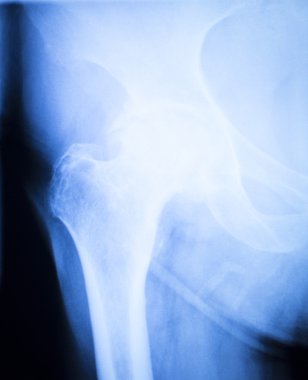 Artritik kalça xray test tarama sonuçları
