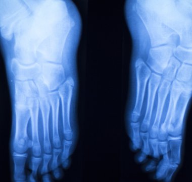 Ayak ve ayak parmakları yaralanma x-ray tarama