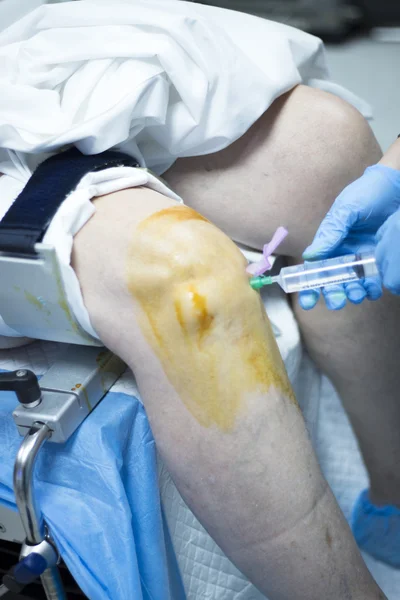 무릎 관절 정형 외과 작업 — 스톡 사진