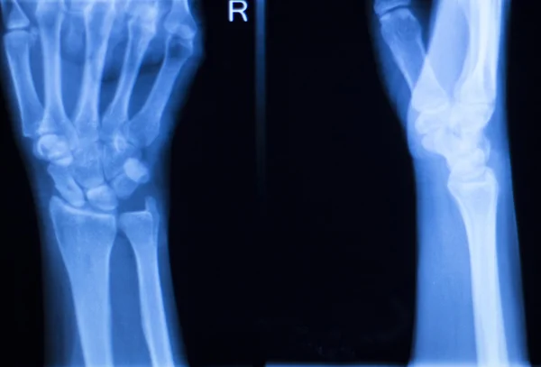 Хірургічне сканування імплантації руки ліктя рентгенівського тесту — стокове фото