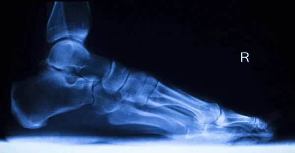 Рентген стоп и пальцев ног — стоковое фото