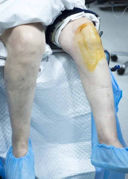 Ортопедическая операция на колене — стоковое фото