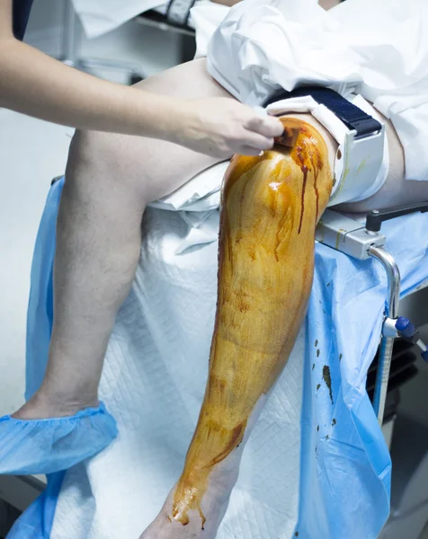 Knie-Arthroskopie orthopädische Operation — Stockfoto