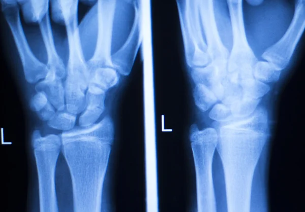 Сканування рентгенівського пальця руки в лікарні — стокове фото