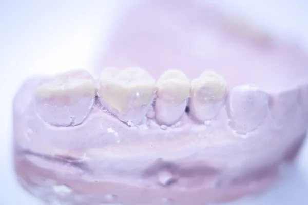 Стоматологічні протези глиняна зубна форма — стокове фото