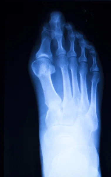 脚和脚趾损伤 x 线扫描 — 图库照片