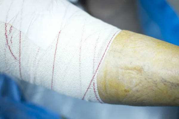 Ортопедическая операция на колене — стоковое фото