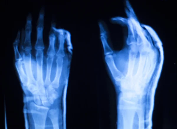 Mão dedo polegar varredura de raios X hospital — Fotografia de Stock