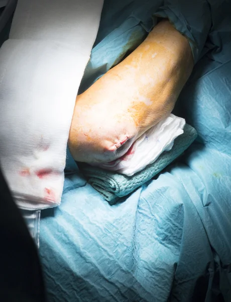 Νοσοκομείο αγκώνα Ορθοπαιδικής χειρουργικής επέμβασης — Φωτογραφία Αρχείου