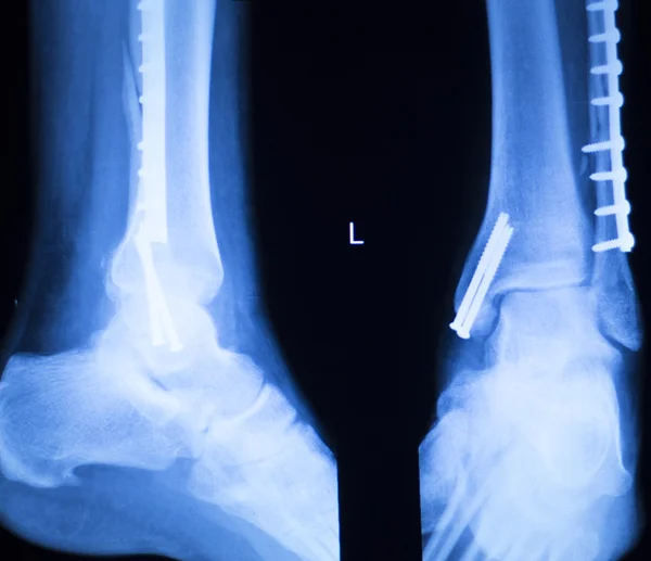 Cheville du pied et balayage des rayons X du tibia — Photo