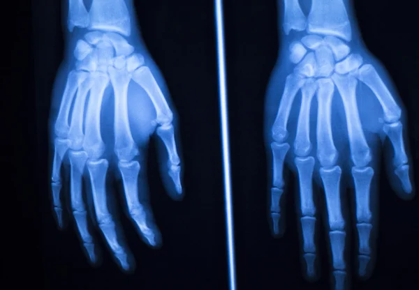 Hand finger thumb hospital xray scan — Stock Photo, Image