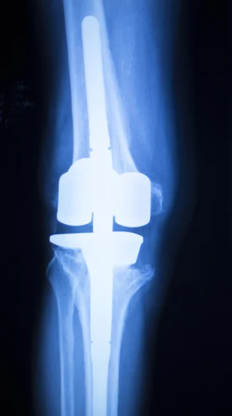 Teste de raio-x do implante articular do joelho — Fotografia de Stock