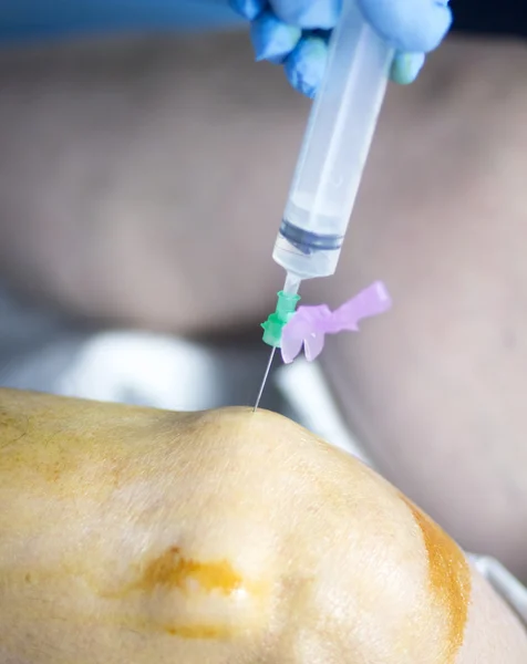 Chirurgia del ginocchio iniezione anestetica — Foto Stock
