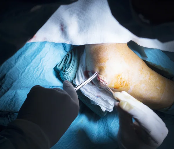 Operazione di chirurgia ortopedica del gomito dell'ospedale — Foto Stock