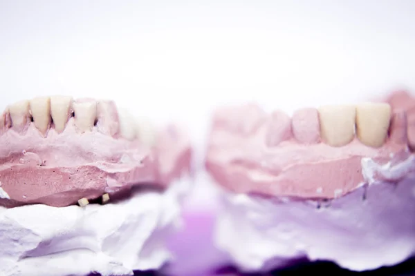 Dental prosthetics clay tooth mold — Stock Photo, Image