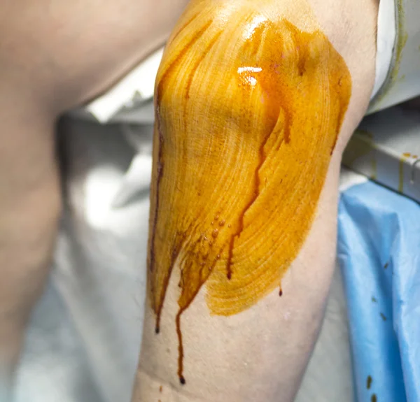Perna esterilizante para cirurgia ortopédica do joelho — Fotografia de Stock