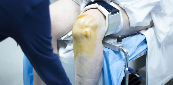 Knie-Arthroskopie orthopädische Operation — Stockfoto