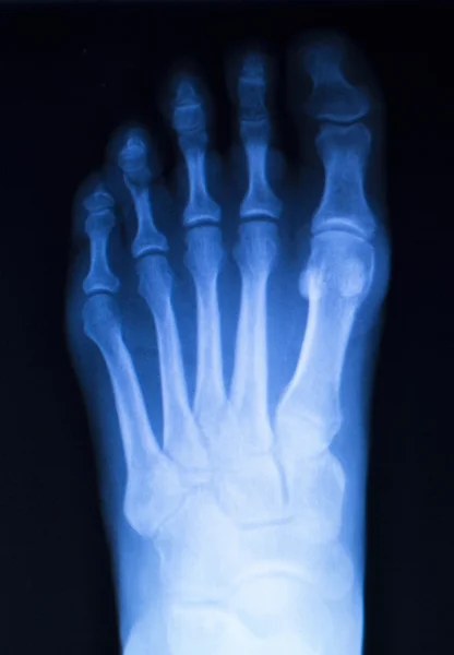 Foot and toes injury x-ray scan — Stock Photo, Image