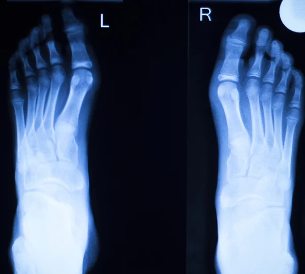 Stopy i palce szkody x-ray skanowania — Zdjęcie stockowe