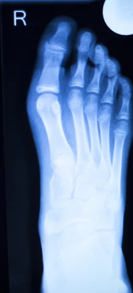 Foot and toes injury x-ray scan — Stock Photo, Image