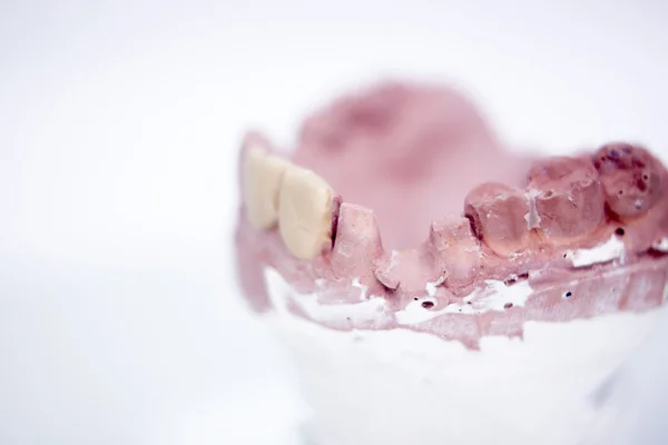 Dentala proteser lera tand mögel — Stockfoto