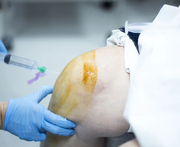 Knee arthroscopy orthopedic surgery operation — Stock Photo, Image