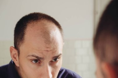 Erkek desenli saç dökülme sorunu kavramı. Kafkasyalı genç bir adam aynaya bakıp kelleşmekten endişeleniyor. Yaklaş. Erkeklerde kellik, saç dökülmesi.