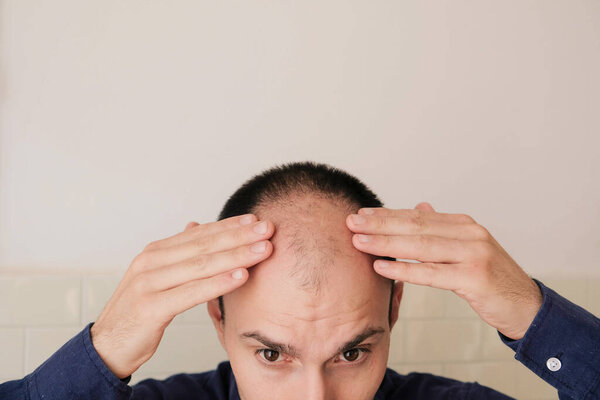 Мужской шаблон проблемы выпадения волос. Молодой кавказский мужчина, глядя в зеркало, беспокоился о лысине. Облысение, облысение у мужчин.