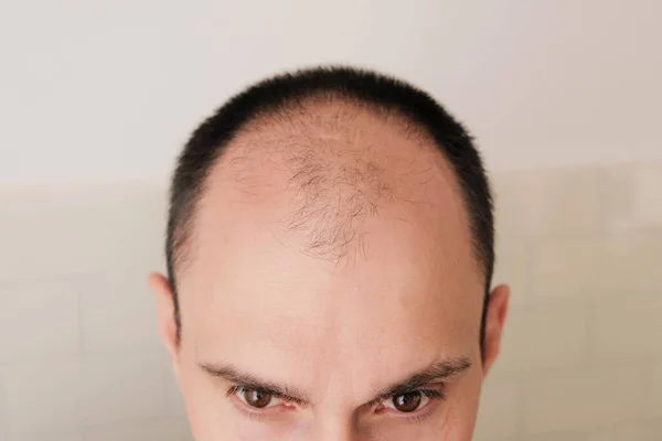 Male pattern hair loss problem concept. Young caucasian man looking at mirror worried about balding, close up. Baldness, alopecia in males.