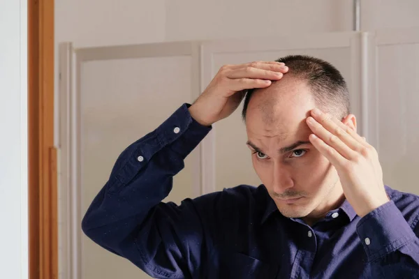 Male pattern hair loss problem concept. Young caucasian man looking at mirror worried about balding. Baldness, alopecia in males.