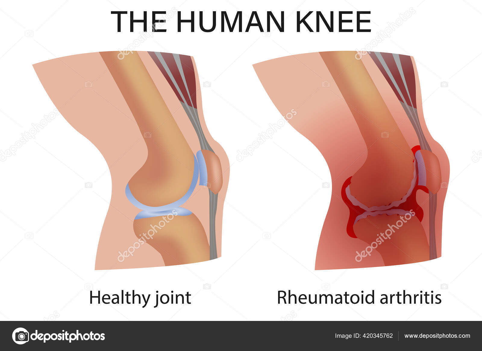 Rheumatoid Arthritis Both Heels Pain Heels Hurt All The Time
