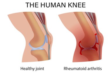 Rheumatoid arthritis. Pain in the joint. degenerative joint disease. The cartilage becomes worn out. This leads to inflammation, swelling, and joint pain. clipart