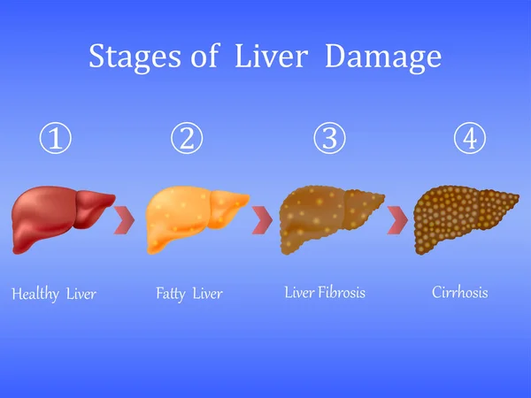 Stages Liver Damage Liver Disease Healthy Fatty Liver Fibrosis Cirrhosis — Stock Vector