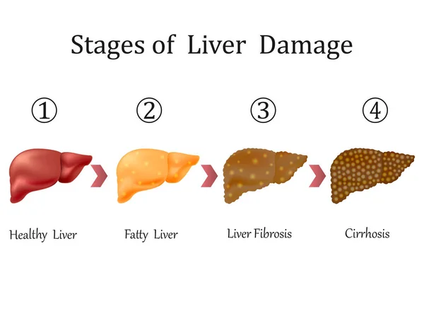 Stages Liver Damage Liver Disease Healthy Fatty Liver Fibrosis Cirrhosis — Stock Vector
