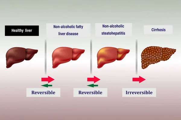 Estágios Danos Fígado Doença Hepática Fibrose Hepática Saudável Gordurosa Cirrose —  Vetores de Stock