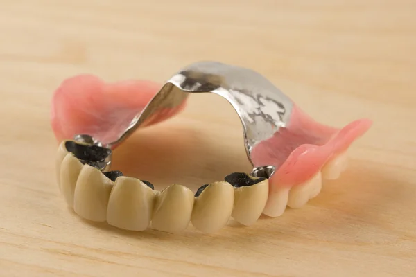 Protesi dentarie con corone in metallo-ceramica — Foto Stock