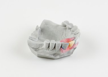 takma diş türü kelebek