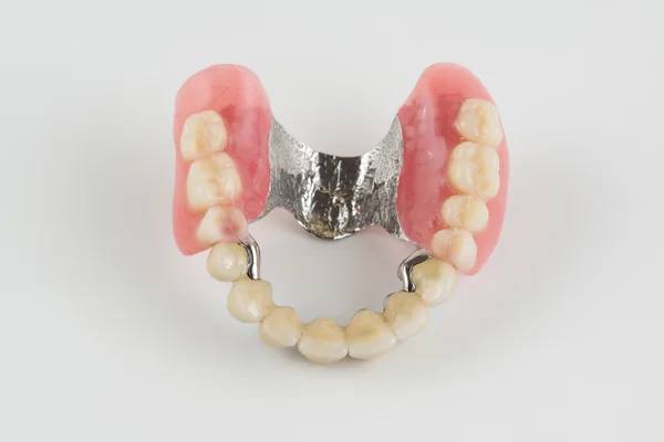 Clasp prosthesis with and latch ceramic crowns — Stock Photo, Image